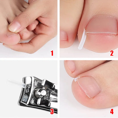 Correcteur d’Ongle Incarné – Patch Élastique Discret