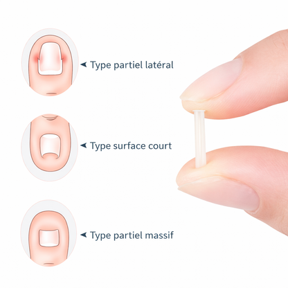 Correcteur d’Ongle Incarné – Patch Élastique Discret